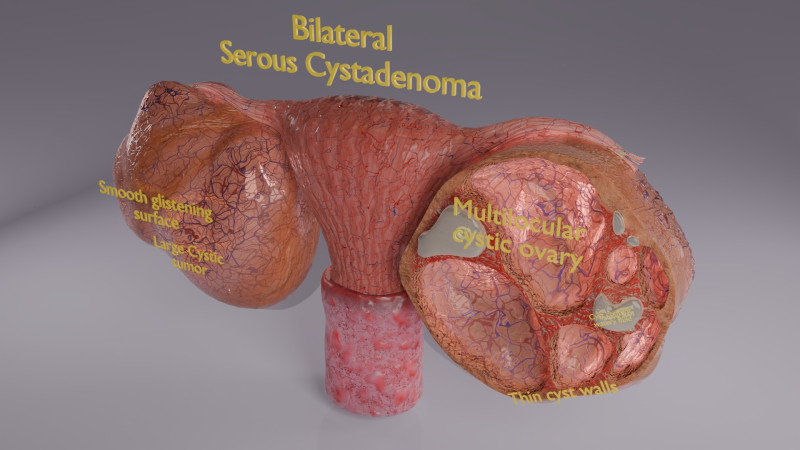 Ovary tumor benign non-cancerous serous cystadenoma Modèle 3D .c4d .max .obj .3ds .fbx .stl .blend 