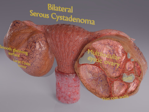 Ovary tumor benign non-cancerous serous cystadenoma 3D Model