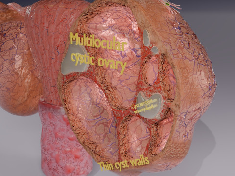 Ovary tumor benign non-cancerous serous cystadenoma Modèle 3D