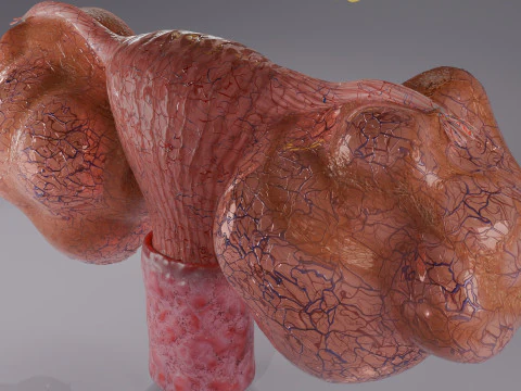 Ovary tumor benign non-cancerous serous cystadenoma 3D Model
