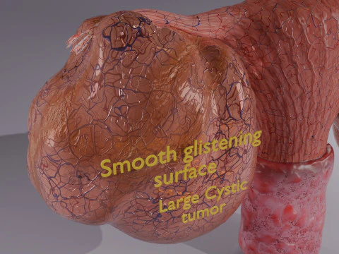 Ovary tumor benign non-cancerous serous cystadenoma 3D Model