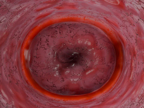 Ovary tumor benign non-cancerous serous cystadenoma 3D Model