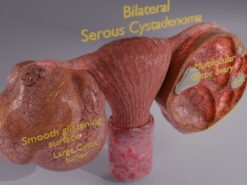 Ovary tumor benign non-cancerous serous cystadenoma Modèle 3D