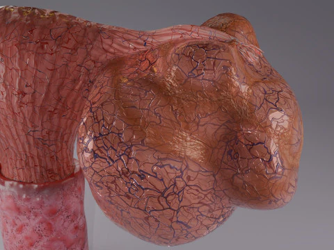Ovary tumor benign non-cancerous serous cystadenoma 3D Model