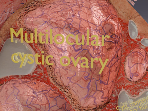 Ovary tumor benign non-cancerous serous cystadenoma Modèle 3D