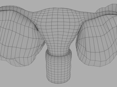 Ovary tumor benign non-cancerous serous cystadenoma Modèle 3D