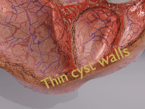Ovary tumor benign non-cancerous serous cystadenoma 3D Model