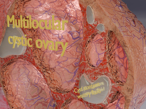 Ovary tumor benign non-cancerous serous cystadenoma Modèle 3D
