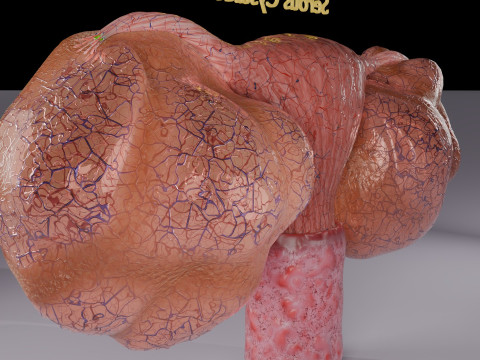 Ovary tumor benign non-cancerous serous cystadenoma Modèle 3D