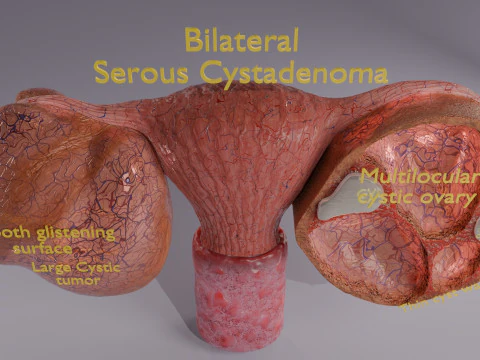 Ovary tumor benign non-cancerous serous cystadenoma 3D Model