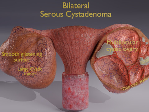 Ovary tumor benign non-cancerous serous cystadenoma Modèle 3D