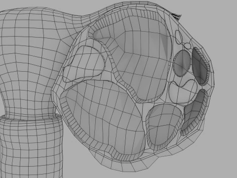Ovary tumor benign non-cancerous serous cystadenoma 3D Model