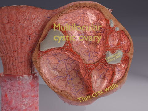 Ovary tumor benign non-cancerous serous cystadenoma Modèle 3D