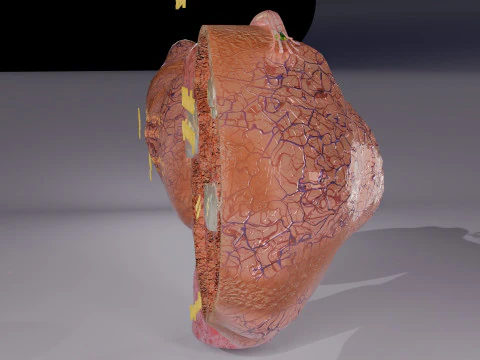 Ovary tumor benign non-cancerous serous cystadenoma 3D Model