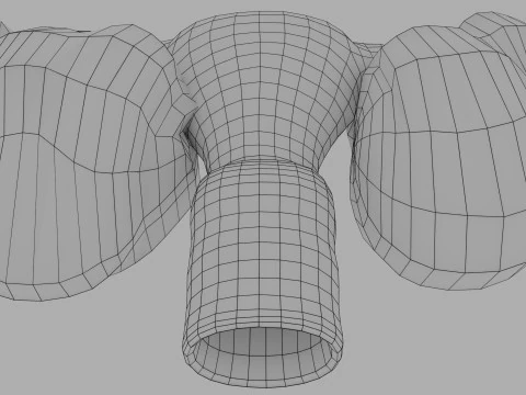 Ovary tumor benign non-cancerous serous cystadenoma 3D Model