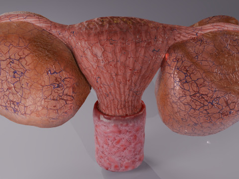 Ovary tumor benign non-cancerous serous cystadenoma Modèle 3D