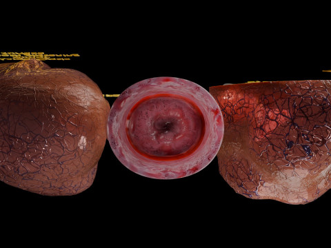 Ovary tumor benign non-cancerous serous cystadenoma Modèle 3D