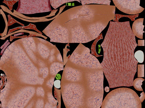 Ovary tumor benign non-cancerous serous cystadenoma 3D Model