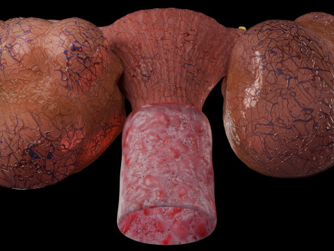 Ovary tumor benign non-cancerous serous cystadenoma Modèle 3D