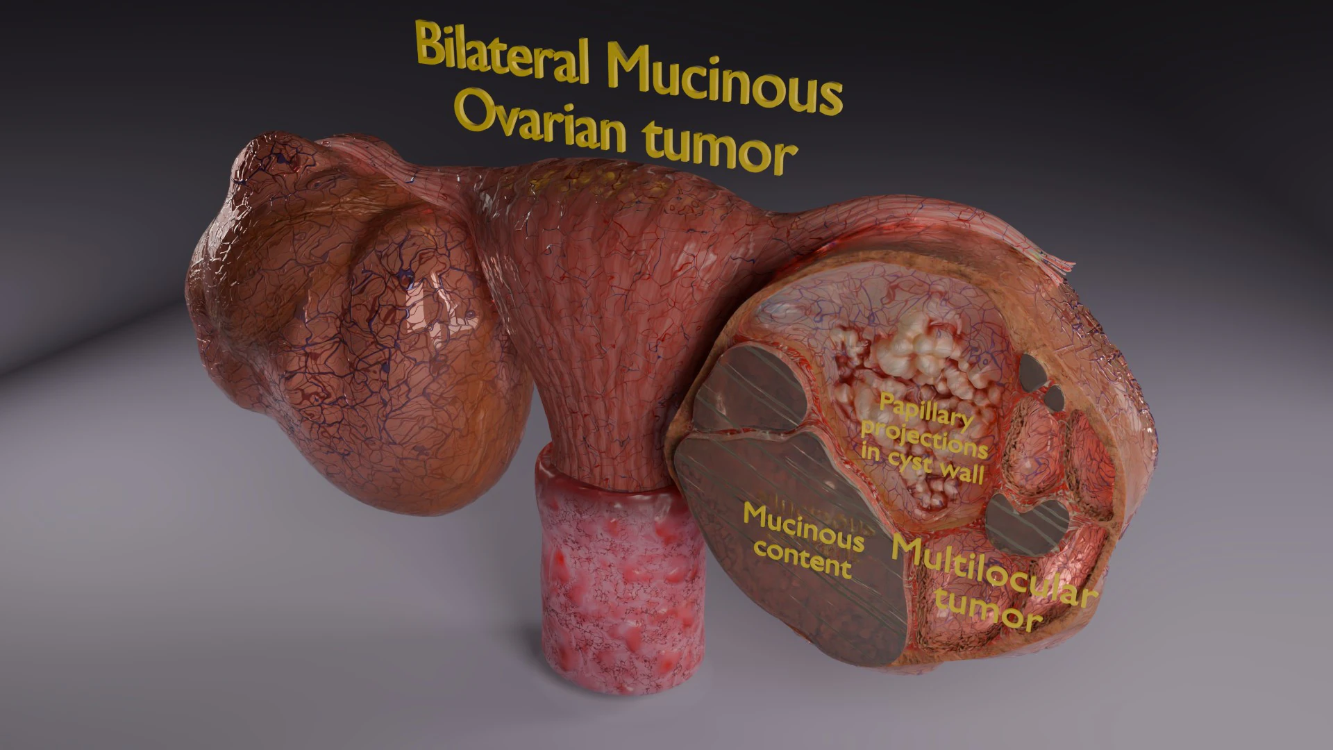 Ovary mucinous cystic tumor 3D Model .c4d .max .obj .3ds .fbx .stl .blend 