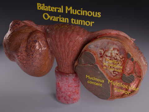 Ovary mucinous cystic tumor Model 3D