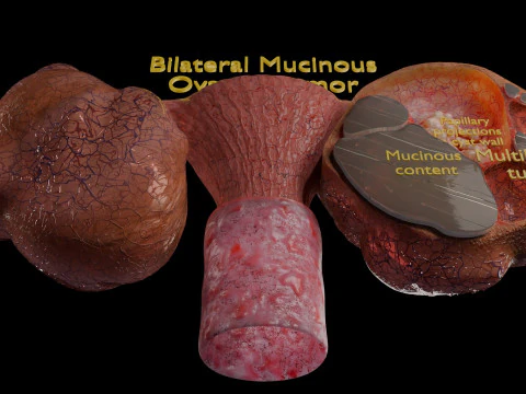 Ovary mucinous cystic tumor 3D Model