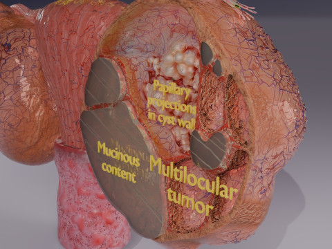 卵巢粘液性囊性肿瘤 3D 模型
