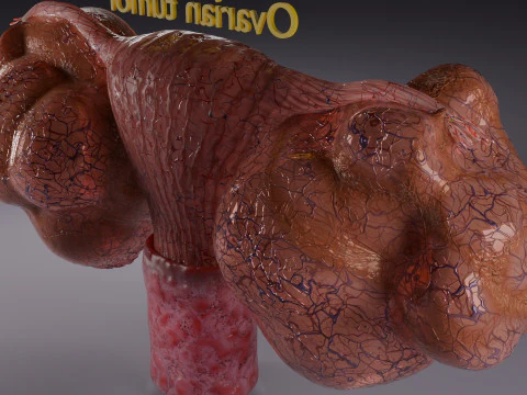 Ovary mucinous cystic tumor 3D Model