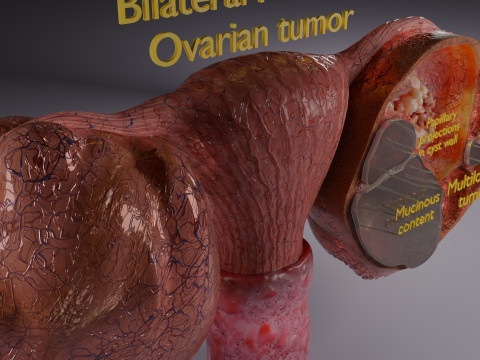 卵巢粘液性囊性肿瘤 3D 模型