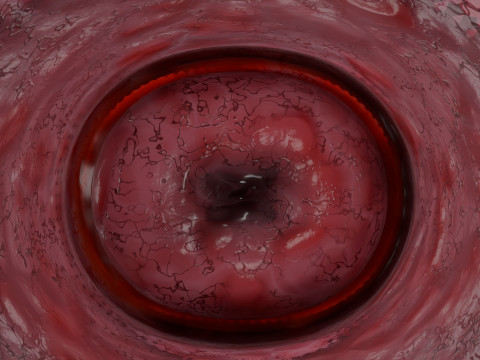 卵巢粘液性囊性肿瘤 3D 模型