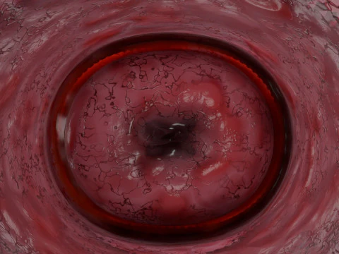 Ovary mucinous cystic tumor 3D Model