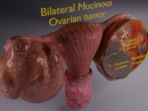 卵巢粘液性囊性肿瘤 3D 模型