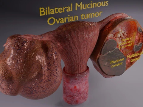 Ovary mucinous cystic tumor 3D Model
