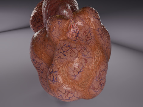 卵巢粘液性囊性肿瘤 3D 模型