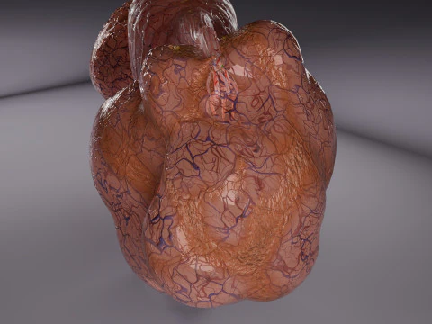 Ovary mucinous cystic tumor 3D Model