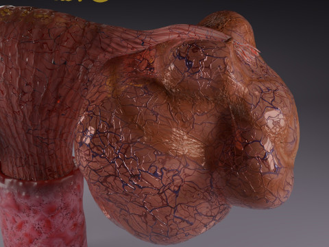 卵巢粘液性囊性肿瘤 3D 模型