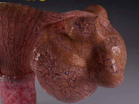 Ovary mucinous cystic tumor 3D Model