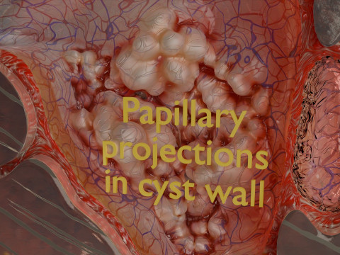 卵巢粘液性囊性肿瘤 3D 模型