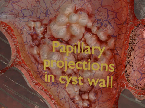 Ovary mucinous cystic tumor 3D Model