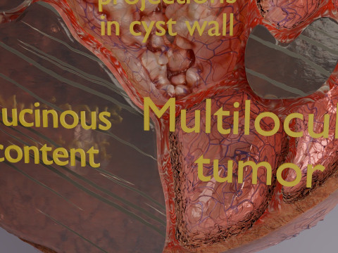 卵巢粘液性囊性肿瘤 3D 模型