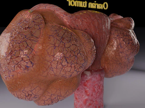 Ovary mucinous cystic tumor 3D Model