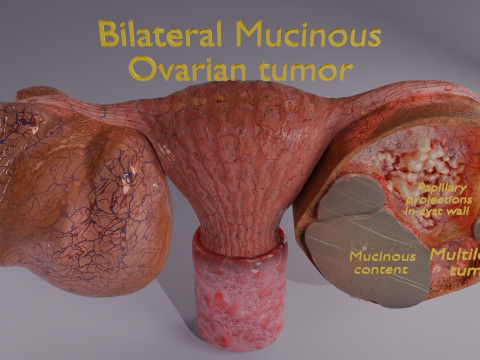 卵巢粘液性囊性肿瘤 3D 模型