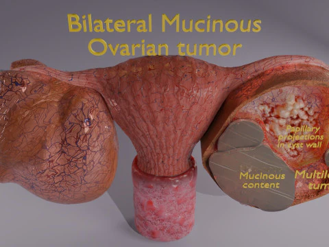 Ovary mucinous cystic tumor 3D Model