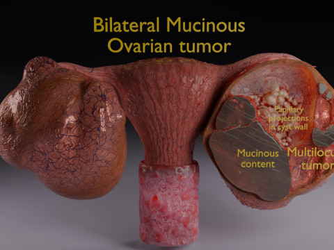 卵巢粘液性囊性肿瘤 3D 模型