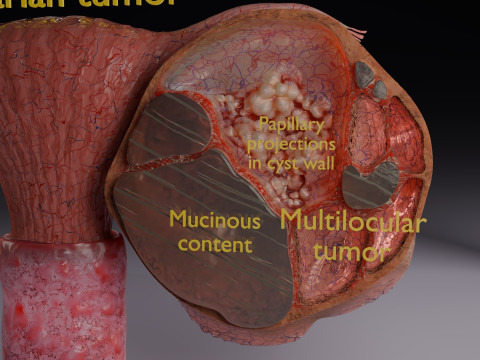 卵巢粘液性囊性肿瘤 3D 模型