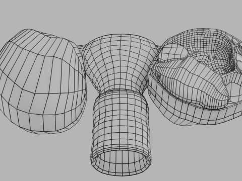 卵巢粘液性囊性肿瘤 3D 模型
