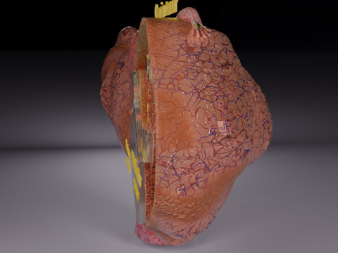 卵巢粘液性囊性肿瘤 3D 模型