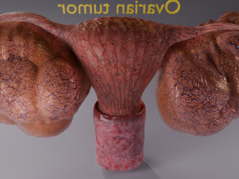 卵巢粘液性囊性肿瘤 3D 模型