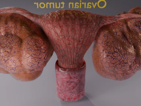 Ovary mucinous cystic tumor 3D Model