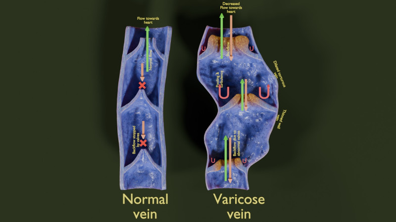 Krampfaderklappe 3D Modell .c4d .max .obj .3ds .fbx .stl .blend 